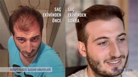 Saç Ekimi Başarı Hikayeleri