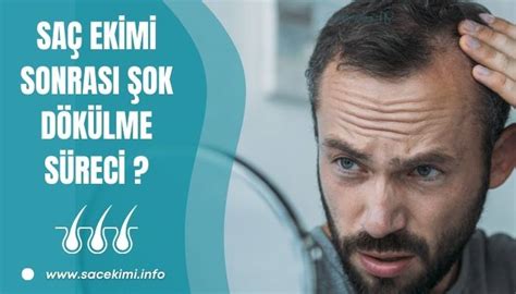 Saç Ekimi Şok Dökülme: Nedir ve Nasıl Geçer?