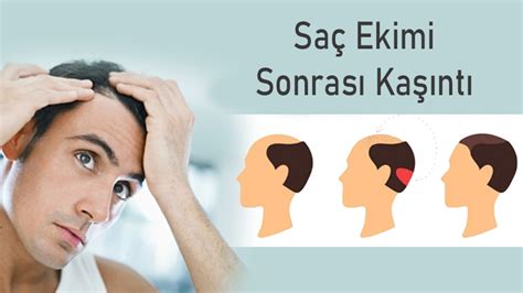 Saç Ekimi Sonrası Kaşıntı: Sebepleri ve Çözümleri